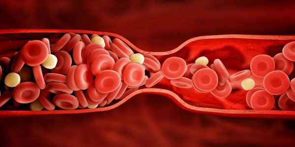 Acenocoumarol is an anticoagulant or blood thinner used to treat and prevent abnormally forming blood clots.