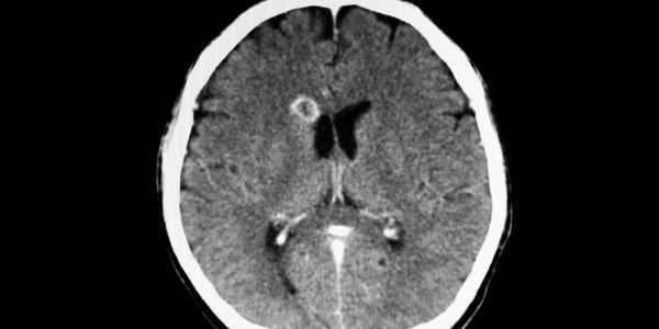 Treating Neurocysticercosis with Albendazole