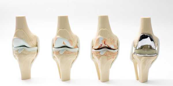 Flurbiprofen – Relief in Osteoarthritis