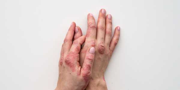 Methoxsalen – Addressing vitiligo and psoriasis