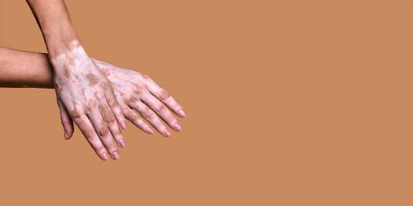 Methoxsalen – Addressing vitiligo and psoriasis