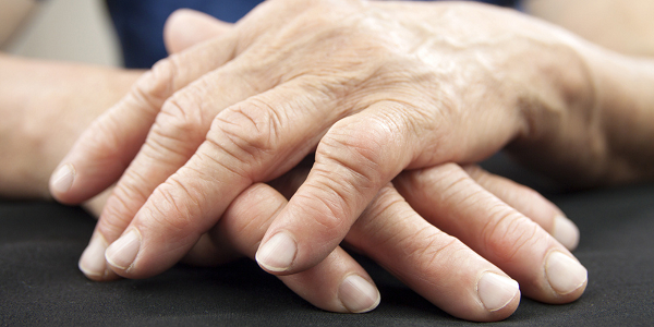 Iguratimod and its efficacy in treating rheumatoid arthritis
